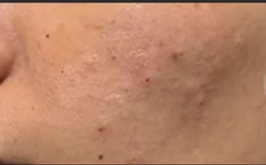 Acne Prone Skin before