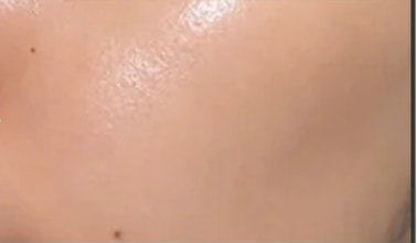 Acne Prone Skin after