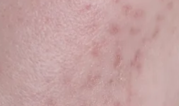 Blemish Mark before