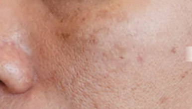 Dark Spot before