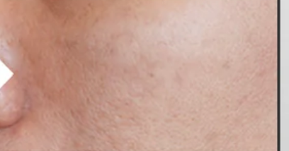 Dark Spot after